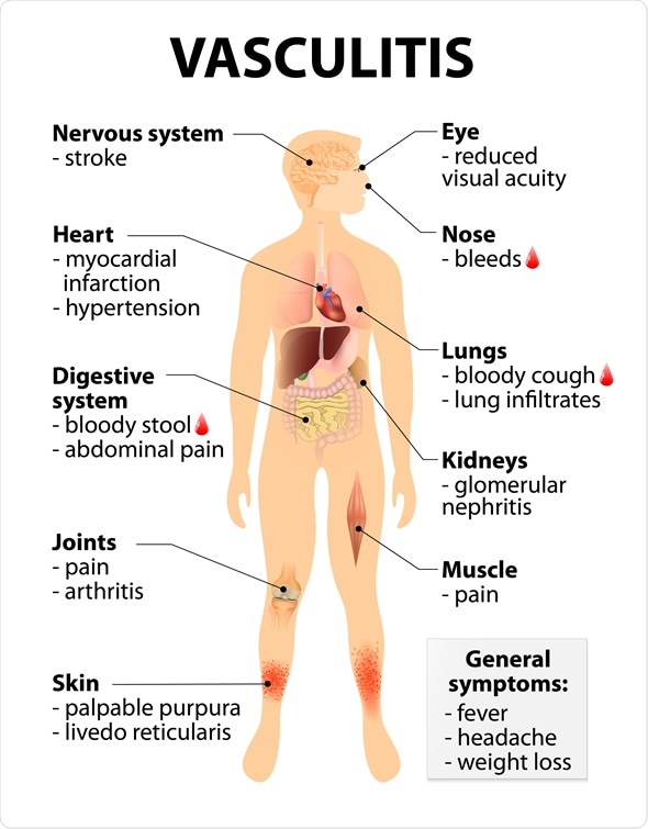 Vasculitis Signs and symptoms. disorders that destroy blood vessels by inflammation. Human silhouette with highlighted internal organs. Image Copyright: Designua / Shutterstock